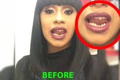 Cardi B teeth